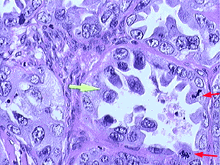 clear cell adenocarcinoma