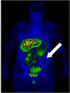   Advanced Ovarian Cancer - Imaging folate-receptors cancer cells using EC20 (folate-Tc99m). Source:  Endocyte
